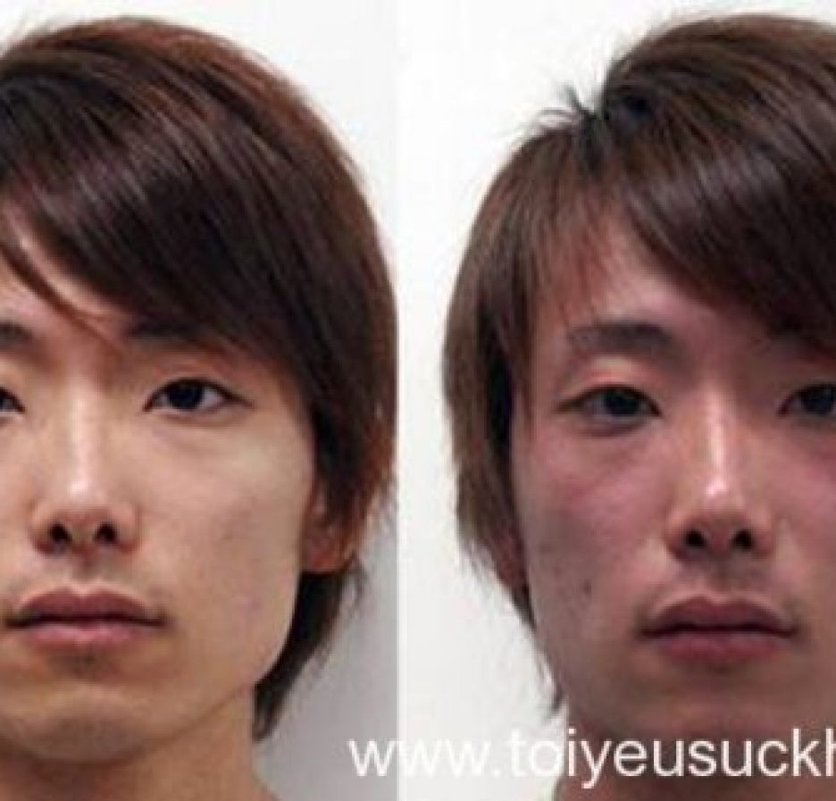 Đỏ mặt khi uống rượu, “tiềm ẩn” nhiều căn bệnh