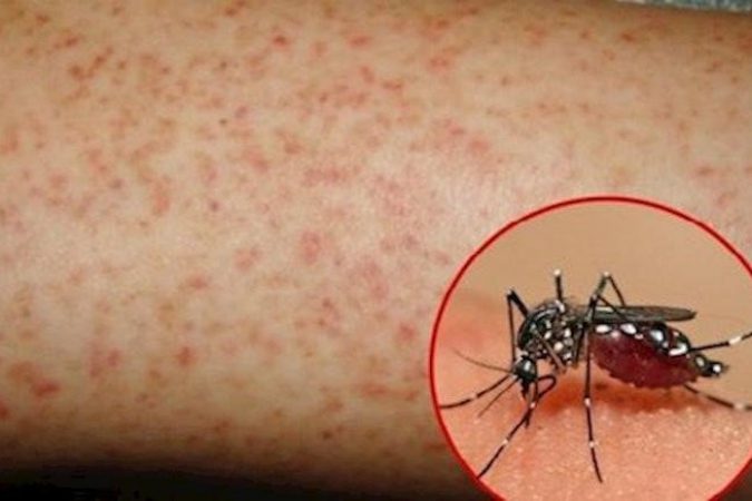 ​Sau mưa lớn muỗi sinh sôi: 6 dấu hiệu nhận biết sốt xuất huyết và cách phòng ngừa hiệu quả