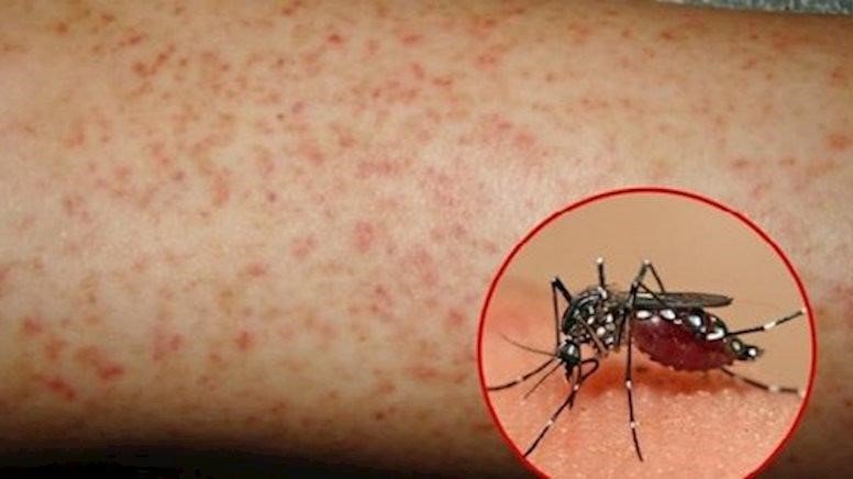 ​Sau mưa lớn muỗi sinh sôi: 6 dấu hiệu nhận biết sốt xuất huyết và cách phòng ngừa hiệu quả